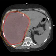 Sample radiation treatment plan demonstrating a 'supermassive' right liver tumor with planned radiation 'isodose lines' shown in bright red and orange.