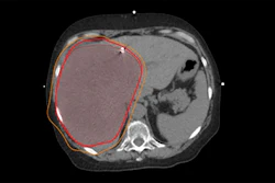 Sample radiation treatment plan demonstrating a 'supermassive' right liver tumor with planned radiation 'isodose lines' shown in bright red and orange.