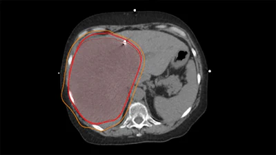 Sample radiation treatment plan demonstrating a 'supermassive' right liver tumor with planned radiation 'isodose lines' shown in bright red and orange.