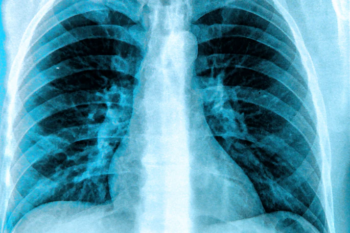 X Ray Chest Lungs