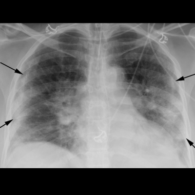2020 09 03 Chest Xray Covid Fig1 400