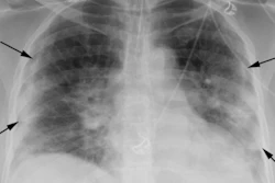 2020 09 03 Chest Xray Covid Fig1 400