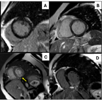 Short-axis phase-sensitive-inversion-recovery (PSIR) sequences show different patterns of late gadolinium enhancement (LGE). A) Linear pattern; B) patchy; C) microvascular obstruction on early gadolinium enhancement (yellow arrow); and D) transmural LGE in patients with elevated IMTG levels.