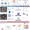 Overview of the study design, including data collection, radiomics model construction, and biologic interpretation. (A) The primary cohort for model development and evaluation in the training and internal test sets includes 168 patients with colorectal cancer (CRC) from center 1 (Fudan University Shanghai Cancer Center), whereas external testing was performed using data from 85 patients from centers 2 (Huashan Hospital, Fudan University) and 3 (Zhongshan Hospital, Fudan University). For model interpretation, RNA sequencing (RNA-seq) data from 18 patients with CRC in center 1 and single-cell data from 35 patients from the Gene Expression Omnibus (GEO) database are incorporated. Mismatch repair (MMR) protein expression, obtained from pathologic reports in electronic medical records (EMRs), was used to identify patients with consensus molecular subtype 1 (CMS1) CRC. Tissue microarrays (TMAs) from surgically obtained CRC tissues were analyzed for immunohistochemical staining of caudal-type homeobox 2 (CDX2), 5-hydroxytryptamine receptor 2B (HTR2B), FERM domain containing 6 (FRMD6), and zinc finger E-box binding homeobox 1 (ZEB1), and the results were subsequently entered into an online classification tool that assigned patients to CMS2, 3, or 4 subtypes. (B) Radiomics workflow for CMS4 prediction. Lesions were manually delineated on T2-weighted imaging (T2WI) and contrast-enhanced (CE) T1-weighted imaging (T1WI), followed by radiomics feature extraction. Feature selection and model development were performed in the training set using machine-learning algorithms with fivefold cross-validation for model selection, and the final model was evaluated in the internal and external test sets using receiver operating characteristic (ROC) curve analysis. (C) Transcriptomic interpretation workflow. Using the radiomics-predicted CMS4 classification, bulk RNA sequencing (RNA-seq) data were used to perform differential expression analysis between predicted CMS4 and non-CMS4 groups, followed by pathway enrichment analyses to assess biologic relevance. Public single-cell RNA sequencing data from the Gene Expression Omnibus database were then used for cell-type–level interrogation to support interpretation of the associated pathways.