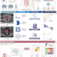 Overview of the study design, including data collection, radiomics model construction, and biologic interpretation. (A) The primary cohort for model development and evaluation in the training and internal test sets includes 168 patients with colorectal cancer (CRC) from center 1 (Fudan University Shanghai Cancer Center), whereas external testing was performed using data from 85 patients from centers 2 (Huashan Hospital, Fudan University) and 3 (Zhongshan Hospital, Fudan University). For model interpretation, RNA sequencing (RNA-seq) data from 18 patients with CRC in center 1 and single-cell data from 35 patients from the Gene Expression Omnibus (GEO) database are incorporated. Mismatch repair (MMR) protein expression, obtained from pathologic reports in electronic medical records (EMRs), was used to identify patients with consensus molecular subtype 1 (CMS1) CRC. Tissue microarrays (TMAs) from surgically obtained CRC tissues were analyzed for immunohistochemical staining of caudal-type homeobox 2 (CDX2), 5-hydroxytryptamine receptor 2B (HTR2B), FERM domain containing 6 (FRMD6), and zinc finger E-box binding homeobox 1 (ZEB1), and the results were subsequently entered into an online classification tool that assigned patients to CMS2, 3, or 4 subtypes. (B) Radiomics workflow for CMS4 prediction. Lesions were manually delineated on T2-weighted imaging (T2WI) and contrast-enhanced (CE) T1-weighted imaging (T1WI), followed by radiomics feature extraction. Feature selection and model development were performed in the training set using machine-learning algorithms with fivefold cross-validation for model selection, and the final model was evaluated in the internal and external test sets using receiver operating characteristic (ROC) curve analysis. (C) Transcriptomic interpretation workflow. Using the radiomics-predicted CMS4 classification, bulk RNA sequencing (RNA-seq) data were used to perform differential expression analysis between predicted CMS4 and non-CMS4 groups, followed by pathway enrichment analyses to assess biologic relevance. Public single-cell RNA sequencing data from the Gene Expression Omnibus database were then used for cell-type–level interrogation to support interpretation of the associated pathways.