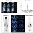 A 68Ga-RCC78 PET scan (C) of a patient four years post-radical right nephrectomy. During follow-up, new nodules were detected in the left adrenal gland and kidney. CAIX-targeted scan clearly visualized metastatic lesions in the mediastinum, pancreas, adrenal gland, and kidney (SUVmax > 30), demonstrating the tracer's ability to maintain high tumor uptake despite significantly reduced abdominal background.
