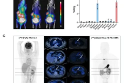 A 68Ga-RCC78 PET scan (C) of a patient four years post-radical right nephrectomy. During follow-up, new nodules were detected in the left adrenal gland and kidney. CAIX-targeted scan clearly visualized metastatic lesions in the mediastinum, pancreas, adrenal gland, and kidney (SUVmax > 30), demonstrating the tracer's ability to maintain high tumor uptake despite significantly reduced abdominal background.