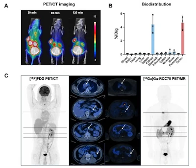 A 68Ga-RCC78 PET scan (C) of a patient four years post-radical right nephrectomy. During follow-up, new nodules were detected in the left adrenal gland and kidney. CAIX-targeted scan clearly visualized metastatic lesions in the mediastinum, pancreas, adrenal gland, and kidney (SUVmax > 30), demonstrating the tracer's ability to maintain high tumor uptake despite significantly reduced abdominal background.