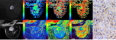 Analysis of a 49-year-old woman who was diagnosed with triple-negative breast cancer depicts (left to right) IVIM maps, IVIM pseudo-colored maps, DCE-MRI maps of the patient, along with DCE-MRI pseudo-colored maps for Ktrans, Kep, Ve, Ktrans, Kep, and Ve, and PD-L1 IHC testing for the patient (×400).