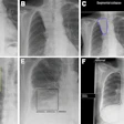 Cropped secondary capture examples. These are illustrative and not intended to imply superiority or inferiority of any device. (A) Posteroanterior radiograph in a 46-year-old female patient. The device correctly identified a right lower lobe nodule projected below the right hemidiaphragm and hilar lymphadenopathy. (B) Posteroanterior radiograph in an 86-year-old female patient with a classic Golden S sign highly suggestive of cancer. Three devices did not identify any findings. (C) The output from one device for the same radiograph as in B. The device placed a contour around the area of abnormality but mislabeled it as segmental collapse, and there are no other elements in the output to raise suspicion of cancer. (D) Posteroanterior radiograph in a 60-year-old male patient -- a case of confirmed lung cancer that was not deemed visible in retrospect. The device identified multiple false-positive abnormalities. (E) Posteroanterior radiograph in a 77-year-old female patient with two right lower lobe nodules. The device mislabeled the abnormality as infection -- a diagnostic term that could incorrectly influence clinical management. (F) Posteroanterior radiograph in a 77-year-old female patient with a right hilar tumor. Most of the lungs have been labeled by the device, with excessive overlap of the abnormality that pragmatically represents an incorrect result. All annotations shown were produced by the devices. LL = lung lesion, LO = lung opacity, PO = pleural other, TBC = tuberculosis.