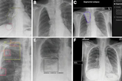 Cropped secondary capture examples. These are illustrative and not intended to imply superiority or inferiority of any device. (A) Posteroanterior radiograph in a 46-year-old female patient. The device correctly identified a right lower lobe nodule projected below the right hemidiaphragm and hilar lymphadenopathy. (B) Posteroanterior radiograph in an 86-year-old female patient with a classic Golden S sign highly suggestive of cancer. Three devices did not identify any findings. (C) The output from one device for the same radiograph as in B. The device placed a contour around the area of abnormality but mislabeled it as segmental collapse, and there are no other elements in the output to raise suspicion of cancer. (D) Posteroanterior radiograph in a 60-year-old male patient -- a case of confirmed lung cancer that was not deemed visible in retrospect. The device identified multiple false-positive abnormalities. (E) Posteroanterior radiograph in a 77-year-old female patient with two right lower lobe nodules. The device mislabeled the abnormality as infection -- a diagnostic term that could incorrectly influence clinical management. (F) Posteroanterior radiograph in a 77-year-old female patient with a right hilar tumor. Most of the lungs have been labeled by the device, with excessive overlap of the abnormality that pragmatically represents an incorrect result. All annotations shown were produced by the devices. LL = lung lesion, LO = lung opacity, PO = pleural other, TBC = tuberculosis.