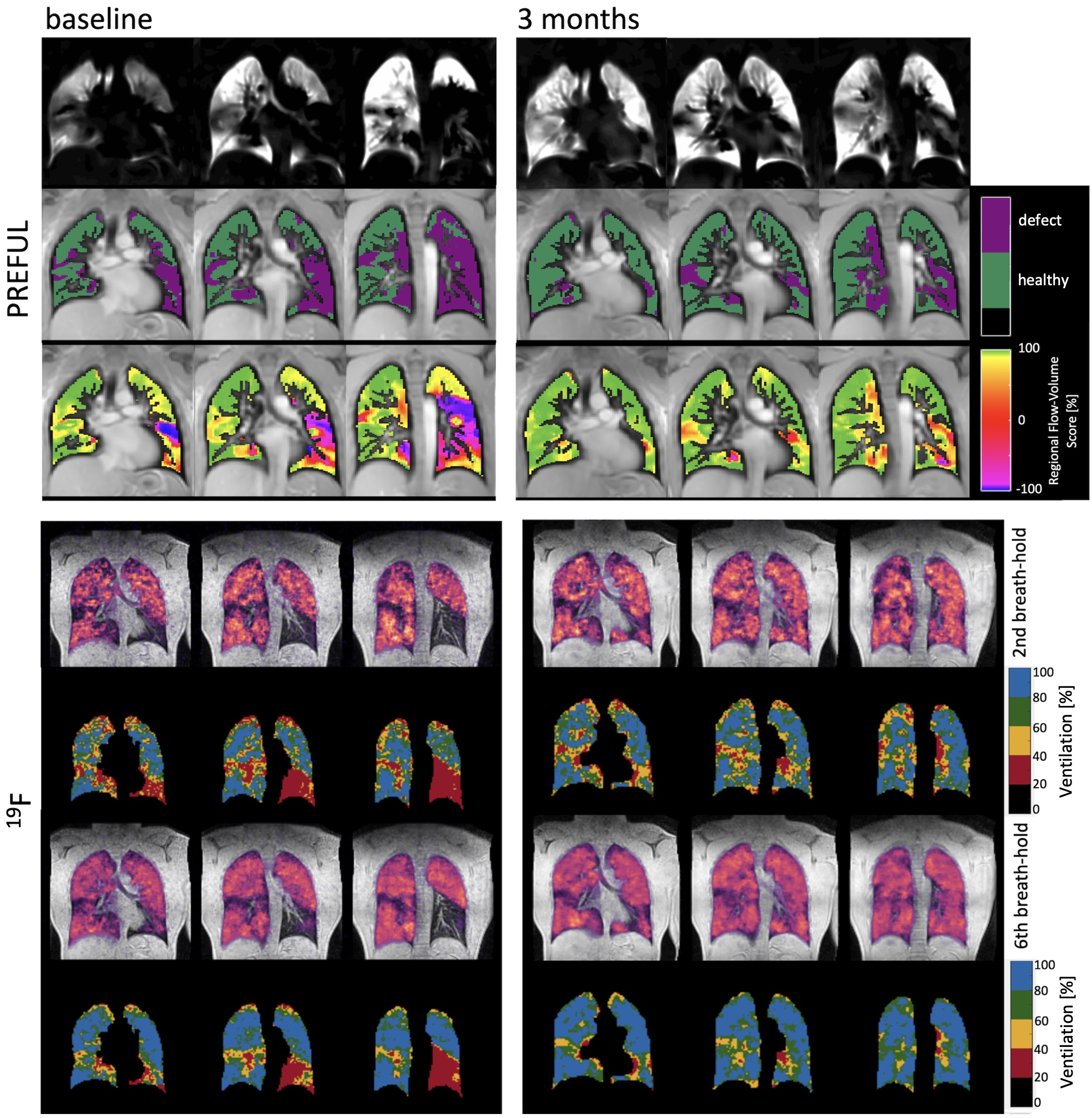 Representative PREFUL and F-19 MRI results at baseline and three months of a male responder (age: 47). First row: PREFUL ventilation images; Second row: Ventilation defect percentage (VDP) maps; Third row: Flow-volume loop (FVL) maps. VDP changed from 54% to 23% and the FVL score over the whole lung increased from 88% to 98%. Fourth and fifth rows: second breath-hold F-19 ventilation with corresponding VDP map; sixth and seventh rows: sixth breath-hold F-19 ventilation with corresponding VDP map. Second VDP decreased from 26% to 10% and 6th VDP from 16% to 3%.