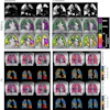 Representative PREFUL and F-19 MRI results at baseline and three months of a male responder (age: 47). First row: PREFUL ventilation images; Second row: Ventilation defect percentage (VDP) maps; Third row: Flow-volume loop (FVL) maps. VDP changed from 54% to 23% and the FVL score over the whole lung increased from 88% to 98%. Fourth and fifth rows: second breath-hold F-19 ventilation with corresponding VDP map; sixth and seventh rows: sixth breath-hold F-19 ventilation with corresponding VDP map. Second VDP decreased from 26% to 10% and 6th VDP from 16% to 3%.