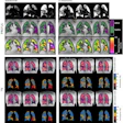 Representative PREFUL and F-19 MRI results at baseline and three months of a male responder (age: 47). First row: PREFUL ventilation images; Second row: Ventilation defect percentage (VDP) maps; Third row: Flow-volume loop (FVL) maps. VDP changed from 54% to 23% and the FVL score over the whole lung increased from 88% to 98%. Fourth and fifth rows: second breath-hold F-19 ventilation with corresponding VDP map; sixth and seventh rows: sixth breath-hold F-19 ventilation with corresponding VDP map. Second VDP decreased from 26% to 10% and 6th VDP from 16% to 3%.