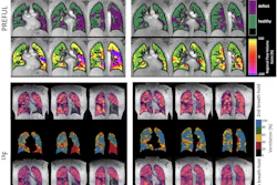 Representative PREFUL and F-19 MRI results at baseline and three months of a male responder (age: 47). First row: PREFUL ventilation images; Second row: Ventilation defect percentage (VDP) maps; Third row: Flow-volume loop (FVL) maps. VDP changed from 54% to 23% and the FVL score over the whole lung increased from 88% to 98%. Fourth and fifth rows: second breath-hold F-19 ventilation with corresponding VDP map; sixth and seventh rows: sixth breath-hold F-19 ventilation with corresponding VDP map. Second VDP decreased from 26% to 10% and 6th VDP from 16% to 3%.