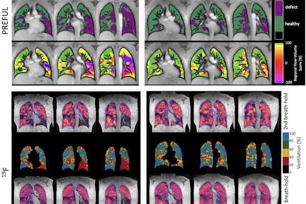Representative PREFUL and F-19 MRI results at baseline and three months of a male responder (age: 47). First row: PREFUL ventilation images; Second row: Ventilation defect percentage (VDP) maps; Third row: Flow-volume loop (FVL) maps. VDP changed from 54% to 23% and the FVL score over the whole lung increased from 88% to 98%. Fourth and fifth rows: second breath-hold F-19 ventilation with corresponding VDP map; sixth and seventh rows: sixth breath-hold F-19 ventilation with corresponding VDP map. Second VDP decreased from 26% to 10% and 6th VDP from 16% to 3%.