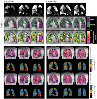 Representative PREFUL and F-19 MRI results at baseline and three months of a male responder (age: 47). First row: PREFUL ventilation images; Second row: Ventilation defect percentage (VDP) maps; Third row: Flow-volume loop (FVL) maps. VDP changed from 54% to 23% and the FVL score over the whole lung increased from 88% to 98%. Fourth and fifth rows: second breath-hold F-19 ventilation with corresponding VDP map; sixth and seventh rows: sixth breath-hold F-19 ventilation with corresponding VDP map. Second VDP decreased from 26% to 10% and 6th VDP from 16% to 3%.
