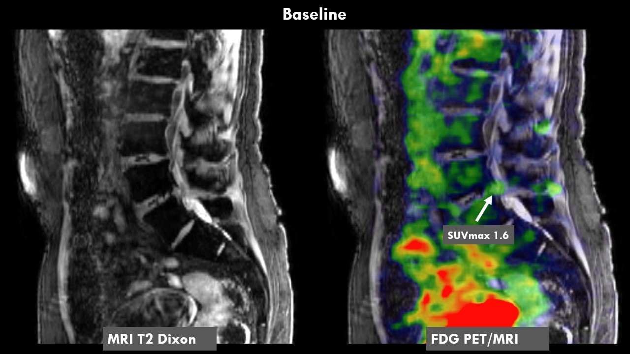 A 70-year-old female patient with chronic low back pain. History of radicular syndrome which led to targeted nerve block with positive effect. However, lower back pain persisted. FDG-PET/MRI showed increased FDG uptake in a disc herniation at L5-S1 (SUVmax 1.6) convincing the treating physician to proceed to discectomy. After discectomy, the patient is now mostly pain free.