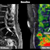 A 70-year-old female patient with chronic low back pain. History of radicular syndrome which led to targeted nerve block with positive effect. However, lower back pain persisted. FDG-PET/MRI showed increased FDG uptake in a disc herniation at L5-S1 (SUVmax 1.6) convincing the treating physician to proceed to discectomy. After discectomy, the patient is now mostly pain free.