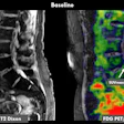 A 70-year-old female patient with chronic low back pain. History of radicular syndrome which led to targeted nerve block with positive effect. However, lower back pain persisted. FDG-PET/MRI showed increased FDG uptake in a disc herniation at L5-S1 (SUVmax 1.6) convincing the treating physician to proceed to discectomy. After discectomy, the patient is now mostly pain free.