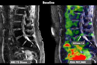 A 70-year-old female patient with chronic low back pain. History of radicular syndrome which led to targeted nerve block with positive effect. However, lower back pain persisted. FDG-PET/MRI showed increased FDG uptake in a disc herniation at L5-S1 (SUVmax 1.6) convincing the treating physician to proceed to discectomy. After discectomy, the patient is now mostly pain free.