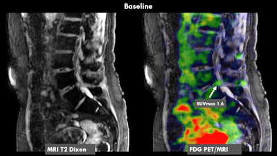 A 70-year-old female patient with chronic low back pain. History of radicular syndrome which led to targeted nerve block with positive effect. However, lower back pain persisted. FDG-PET/MRI showed increased FDG uptake in a disc herniation at L5-S1 (SUVmax 1.6) convincing the treating physician to proceed to discectomy. After discectomy, the patient is now mostly pain free.