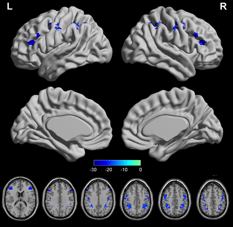 The PPD group showed significant increased VMHC in the dorsolateral prefrontal cortex (DLPFC), precentral gyrus (PreCG) and parietal lobule (PL) (FDR correction q-value < 0.005).