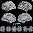 The PPD group showed significant increased VMHC in the dorsolateral prefrontal cortex (DLPFC), precentral gyrus (PreCG) and parietal lobule (PL) (FDR correction q-value < 0.005).
