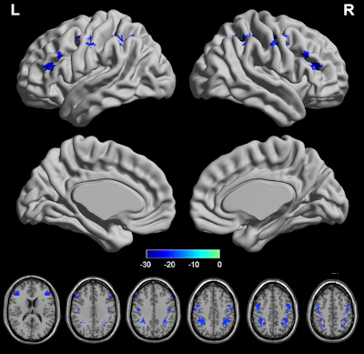ISMRM: Brain activity changes, birth trauma linked in postpartum PTSD