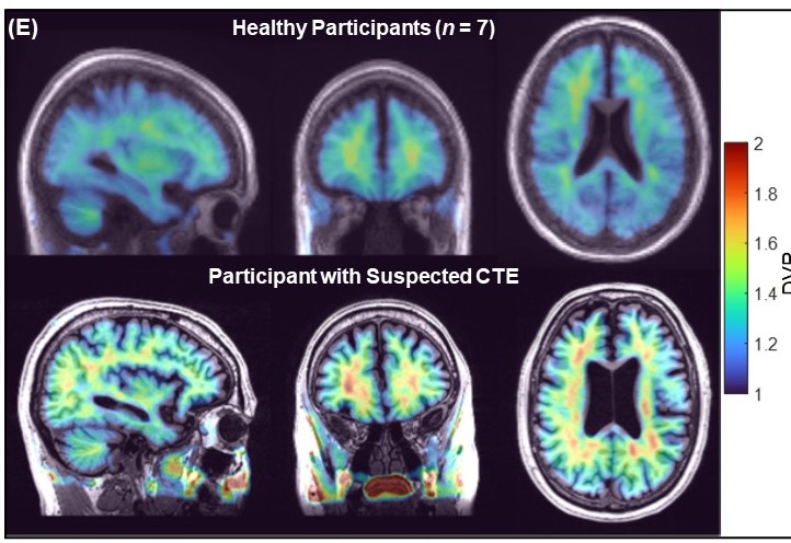 Parametric maps obtained with SRTM2 (cerebellum grey matter as reference) for the group of healthy participants (top) and from one representative participant with suspected CTE (bottom). CTE: chronic traumatic encephalopathy.