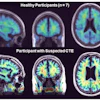Parametric maps obtained with SRTM2 (cerebellum grey matter as reference) for the group of healthy participants (top) and from one representative participant with suspected CTE (bottom). CTE: chronic traumatic encephalopathy.