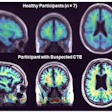 Parametric maps obtained with SRTM2 (cerebellum grey matter as reference) for the group of healthy participants (top) and from one representative participant with suspected CTE (bottom). CTE: chronic traumatic encephalopathy.