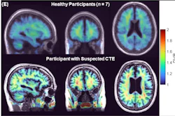 Parametric maps obtained with SRTM2 (cerebellum grey matter as reference) for the group of healthy participants (top) and from one representative participant with suspected CTE (bottom). CTE: chronic traumatic encephalopathy.