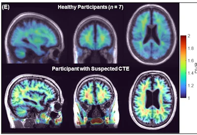 Parametric maps obtained with SRTM2 (cerebellum grey matter as reference) for the group of healthy participants (top) and from one representative participant with suspected CTE (bottom). CTE: chronic traumatic encephalopathy.