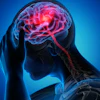 Brain Stroke