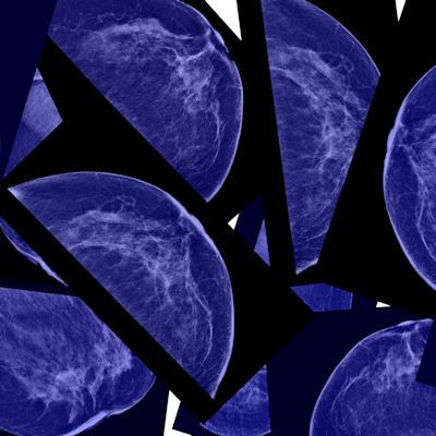 Breast Mammo 400 (1)