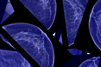 Breast Mammo 400 (1)