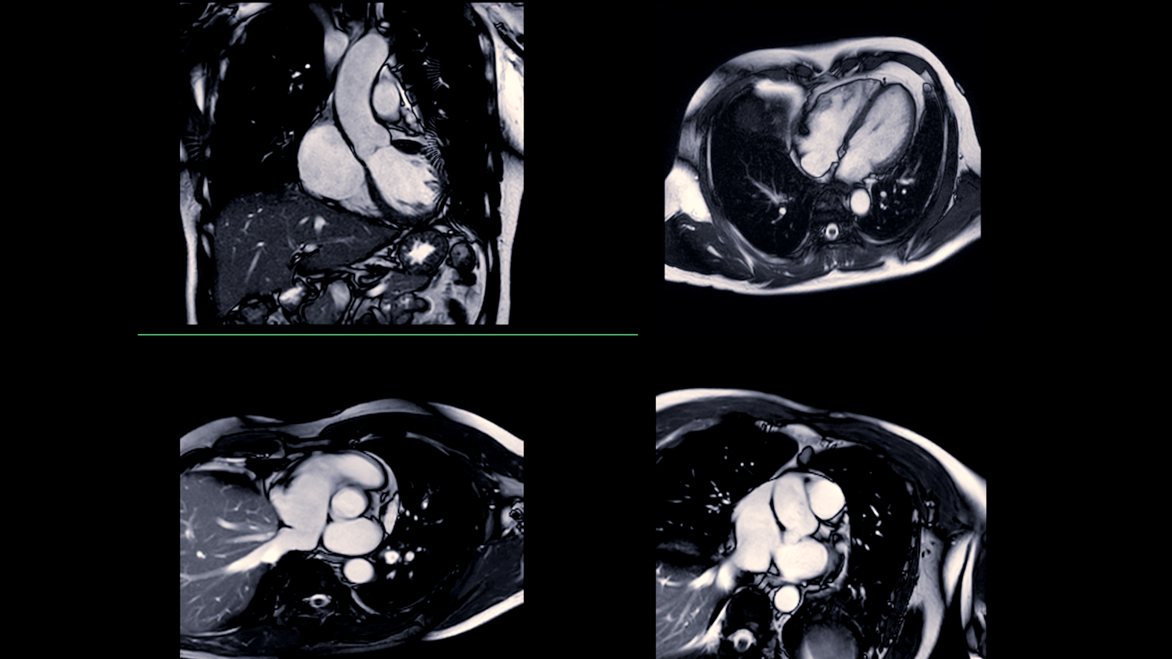 Cardiac Mri Adobe Samunella