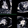 Cardiac Mri Adobe Samunella