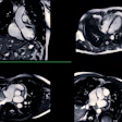 Cardiac Mri Adobe Samunella