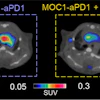 Combination therapy of JAK1i with anti-PD1 slows down tumor growth and reduces CCR2+ cells infiltration in atherosclerotic lesions compared to anti-PD1 alone. Representative PET images of cardio-oncology mice treated with anti-PD1 alone or in combination with JAK1i. The PET uptake was normalized by subtracting blood retention.