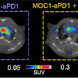 Combination therapy of JAK1i with anti-PD1 slows down tumor growth and reduces CCR2+ cells infiltration in atherosclerotic lesions compared to anti-PD1 alone. Representative PET images of cardio-oncology mice treated with anti-PD1 alone or in combination with JAK1i. The PET uptake was normalized by subtracting blood retention.