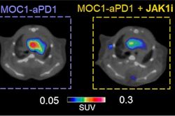 Combination therapy of JAK1i with anti-PD1 slows down tumor growth and reduces CCR2+ cells infiltration in atherosclerotic lesions compared to anti-PD1 alone. Representative PET images of cardio-oncology mice treated with anti-PD1 alone or in combination with JAK1i. The PET uptake was normalized by subtracting blood retention.