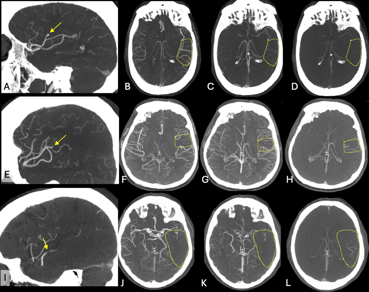 Exemplary cases from the ESCAPE-MeVO trial illustrating good, moderate, and poor collateral status at baseline multiphase CT angiography (CTA). (A) Sagittal image shows a left anterior middle cerebral artery medium-vessel occlusion (MeVO) with a calcified thrombus (arrow). (B&ndash;D) Axial images show the (B) arterial, (C) peak venous, and (D) delayed venous phases of the baseline multiphase CTA examination. The affected brain parenchyma is highlighted by the dashed outline. The collateral status is good, with early filling of more than 50% of the leptomeningeal collaterals compared with the contralateral side in the arterial phase (B), and there is no delayed washout in the peak venous (C) or delayed venous phase (D). (E) Sagittal image shows a left anterior middle cerebral artery MeVO (arrow). (F&ndash;H) Axial images show the (F) arterial, (G) peak venous, and (H) delayed venous phases of the baseline multiphase CTA examination. The affected brain parenchyma is highlighted by the dashed outline. The collateral status is moderate (more than 25% but less than 50% filling of the leptomeningeal collaterals in the affected territory compared with the contralateral side) on the arterial (F) and peak venous (G) phase, and there is delayed washout in the late venous phase (H). (I) Sagittal image shows a posterior dominant middle cerebral artery MeVO (arrow). (J&ndash;L) Axial images show the (J) arterial, (K) peak venous, and (L) delayed venous phases of the baseline multiphase CTA examination. The affected brain parenchyma is highlighted by the dashed outline. The collateral status is poor, with almost no collateral filling.