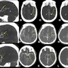 Exemplary cases from the ESCAPE-MeVO trial illustrating good, moderate, and poor collateral status at baseline multiphase CT angiography (CTA). (A) Sagittal image shows a left anterior middle cerebral artery medium-vessel occlusion (MeVO) with a calcified thrombus (arrow). (B–D) Axial images show the (B) arterial, (C) peak venous, and (D) delayed venous phases of the baseline multiphase CTA examination. The affected brain parenchyma is highlighted by the dashed outline. The collateral status is good, with early filling of more than 50% of the leptomeningeal collaterals compared with the contralateral side in the arterial phase (B), and there is no delayed washout in the peak venous (C) or delayed venous phase (D). (E) Sagittal image shows a left anterior middle cerebral artery MeVO (arrow). (F–H) Axial images show the (F) arterial, (G) peak venous, and (H) delayed venous phases of the baseline multiphase CTA examination. The affected brain parenchyma is highlighted by the dashed outline. The collateral status is moderate (more than 25% but less than 50% filling of the leptomeningeal collaterals in the affected territory compared with the contralateral side) on the arterial (F) and peak venous (G) phase, and there is delayed washout in the late venous phase (H). (I) Sagittal image shows a posterior dominant middle cerebral artery MeVO (arrow). (J–L) Axial images show the (J) arterial, (K) peak venous, and (L) delayed venous phases of the baseline multiphase CTA examination. The affected brain parenchyma is highlighted by the dashed outline. The collateral status is poor, with almost no collateral filling.