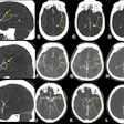 Exemplary cases from the ESCAPE-MeVO trial illustrating good, moderate, and poor collateral status at baseline multiphase CT angiography (CTA). (A) Sagittal image shows a left anterior middle cerebral artery medium-vessel occlusion (MeVO) with a calcified thrombus (arrow). (B–D) Axial images show the (B) arterial, (C) peak venous, and (D) delayed venous phases of the baseline multiphase CTA examination. The affected brain parenchyma is highlighted by the dashed outline. The collateral status is good, with early filling of more than 50% of the leptomeningeal collaterals compared with the contralateral side in the arterial phase (B), and there is no delayed washout in the peak venous (C) or delayed venous phase (D). (E) Sagittal image shows a left anterior middle cerebral artery MeVO (arrow). (F–H) Axial images show the (F) arterial, (G) peak venous, and (H) delayed venous phases of the baseline multiphase CTA examination. The affected brain parenchyma is highlighted by the dashed outline. The collateral status is moderate (more than 25% but less than 50% filling of the leptomeningeal collaterals in the affected territory compared with the contralateral side) on the arterial (F) and peak venous (G) phase, and there is delayed washout in the late venous phase (H). (I) Sagittal image shows a posterior dominant middle cerebral artery MeVO (arrow). (J–L) Axial images show the (J) arterial, (K) peak venous, and (L) delayed venous phases of the baseline multiphase CTA examination. The affected brain parenchyma is highlighted by the dashed outline. The collateral status is poor, with almost no collateral filling.