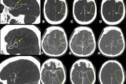 Exemplary cases from the ESCAPE-MeVO trial illustrating good, moderate, and poor collateral status at baseline multiphase CT angiography (CTA). (A) Sagittal image shows a left anterior middle cerebral artery medium-vessel occlusion (MeVO) with a calcified thrombus (arrow). (B–D) Axial images show the (B) arterial, (C) peak venous, and (D) delayed venous phases of the baseline multiphase CTA examination. The affected brain parenchyma is highlighted by the dashed outline. The collateral status is good, with early filling of more than 50% of the leptomeningeal collaterals compared with the contralateral side in the arterial phase (B), and there is no delayed washout in the peak venous (C) or delayed venous phase (D). (E) Sagittal image shows a left anterior middle cerebral artery MeVO (arrow). (F–H) Axial images show the (F) arterial, (G) peak venous, and (H) delayed venous phases of the baseline multiphase CTA examination. The affected brain parenchyma is highlighted by the dashed outline. The collateral status is moderate (more than 25% but less than 50% filling of the leptomeningeal collaterals in the affected territory compared with the contralateral side) on the arterial (F) and peak venous (G) phase, and there is delayed washout in the late venous phase (H). (I) Sagittal image shows a posterior dominant middle cerebral artery MeVO (arrow). (J–L) Axial images show the (J) arterial, (K) peak venous, and (L) delayed venous phases of the baseline multiphase CTA examination. The affected brain parenchyma is highlighted by the dashed outline. The collateral status is poor, with almost no collateral filling.
