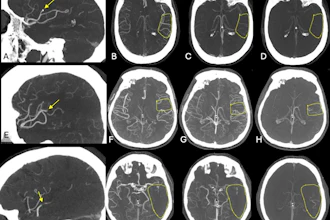 Exemplary cases from the ESCAPE-MeVO trial illustrating good, moderate, and poor collateral status at baseline multiphase CT angiography (CTA). (A) Sagittal image shows a left anterior middle cerebral artery medium-vessel occlusion (MeVO) with a calcified thrombus (arrow). (B–D) Axial images show the (B) arterial, (C) peak venous, and (D) delayed venous phases of the baseline multiphase CTA examination. The affected brain parenchyma is highlighted by the dashed outline. The collateral status is good, with early filling of more than 50% of the leptomeningeal collaterals compared with the contralateral side in the arterial phase (B), and there is no delayed washout in the peak venous (C) or delayed venous phase (D). (E) Sagittal image shows a left anterior middle cerebral artery MeVO (arrow). (F–H) Axial images show the (F) arterial, (G) peak venous, and (H) delayed venous phases of the baseline multiphase CTA examination. The affected brain parenchyma is highlighted by the dashed outline. The collateral status is moderate (more than 25% but less than 50% filling of the leptomeningeal collaterals in the affected territory compared with the contralateral side) on the arterial (F) and peak venous (G) phase, and there is delayed washout in the late venous phase (H). (I) Sagittal image shows a posterior dominant middle cerebral artery MeVO (arrow). (J–L) Axial images show the (J) arterial, (K) peak venous, and (L) delayed venous phases of the baseline multiphase CTA examination. The affected brain parenchyma is highlighted by the dashed outline. The collateral status is poor, with almost no collateral filling.