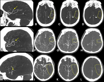 Exemplary cases from the ESCAPE-MeVO trial illustrating good, moderate, and poor collateral status at baseline multiphase CT angiography (CTA). (A) Sagittal image shows a left anterior middle cerebral artery medium-vessel occlusion (MeVO) with a calcified thrombus (arrow). (B–D) Axial images show the (B) arterial, (C) peak venous, and (D) delayed venous phases of the baseline multiphase CTA examination. The affected brain parenchyma is highlighted by the dashed outline. The collateral status is good, with early filling of more than 50% of the leptomeningeal collaterals compared with the contralateral side in the arterial phase (B), and there is no delayed washout in the peak venous (C) or delayed venous phase (D). (E) Sagittal image shows a left anterior middle cerebral artery MeVO (arrow). (F–H) Axial images show the (F) arterial, (G) peak venous, and (H) delayed venous phases of the baseline multiphase CTA examination. The affected brain parenchyma is highlighted by the dashed outline. The collateral status is moderate (more than 25% but less than 50% filling of the leptomeningeal collaterals in the affected territory compared with the contralateral side) on the arterial (F) and peak venous (G) phase, and there is delayed washout in the late venous phase (H). (I) Sagittal image shows a posterior dominant middle cerebral artery MeVO (arrow). (J–L) Axial images show the (J) arterial, (K) peak venous, and (L) delayed venous phases of the baseline multiphase CTA examination. The affected brain parenchyma is highlighted by the dashed outline. The collateral status is poor, with almost no collateral filling.