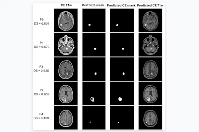 Performance of the qMRI-4-parameters model in five test subjects (P1–P5) with contrast enhancement. The corresponding Dice scores (DS) are shown on the left. CE: contrast-enhanced.